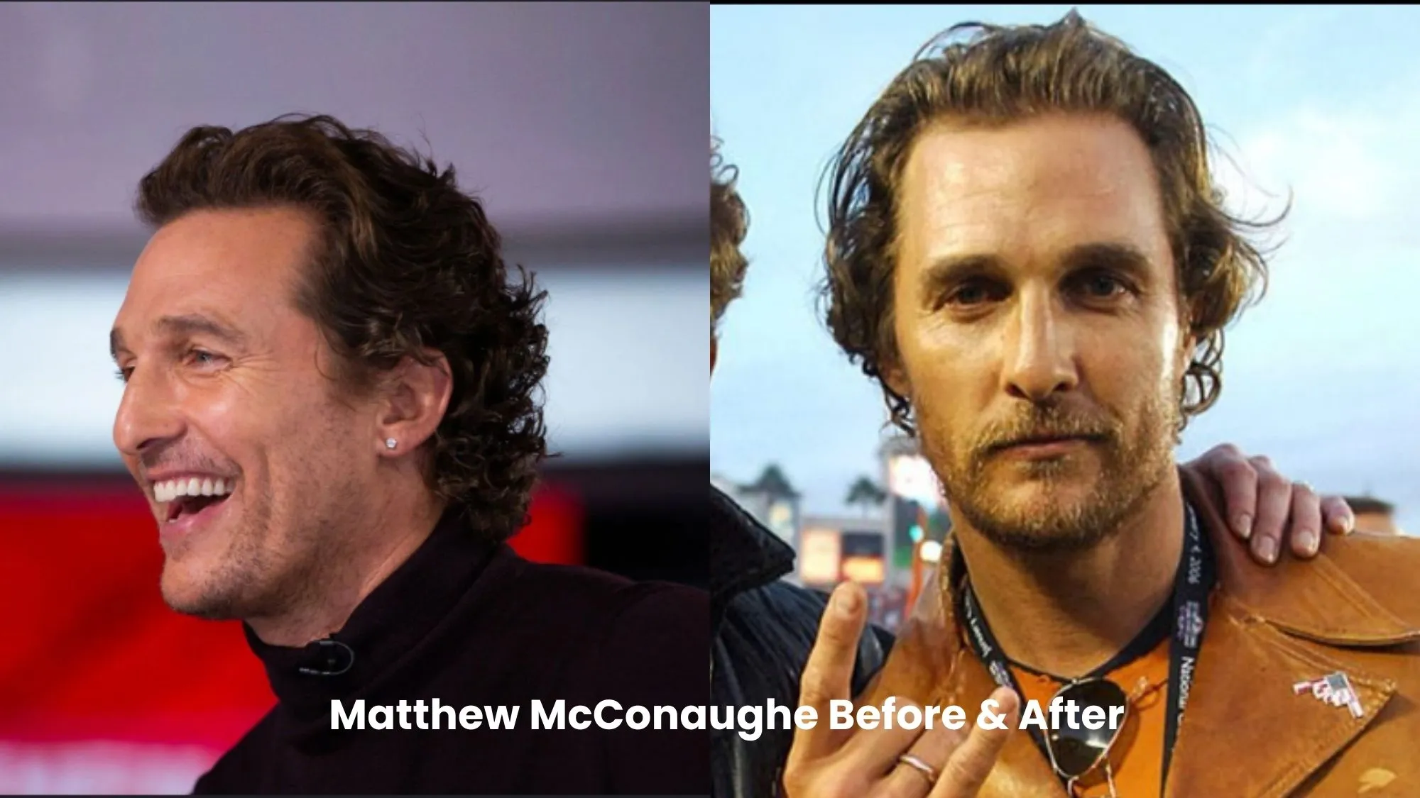 Matthew McConaughey hair transplant