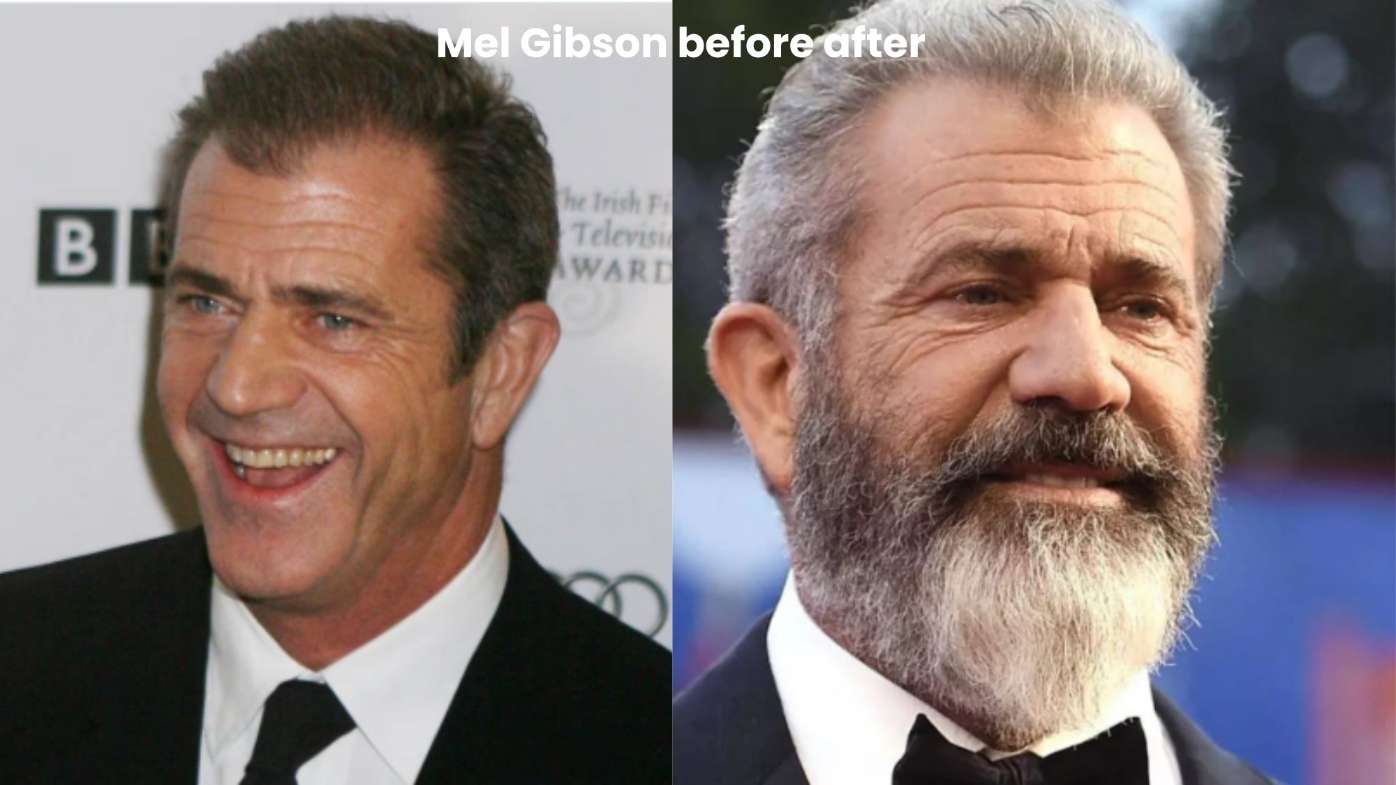 Mel Gibson hair transplant