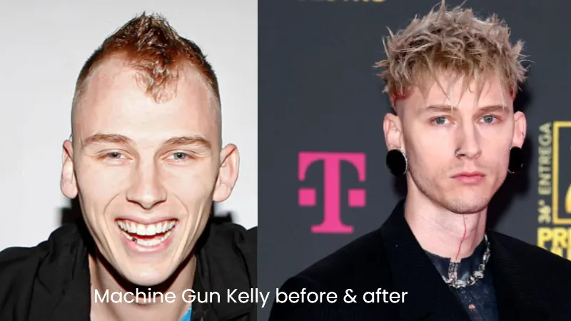 Machine Gun Kelly hair transplant