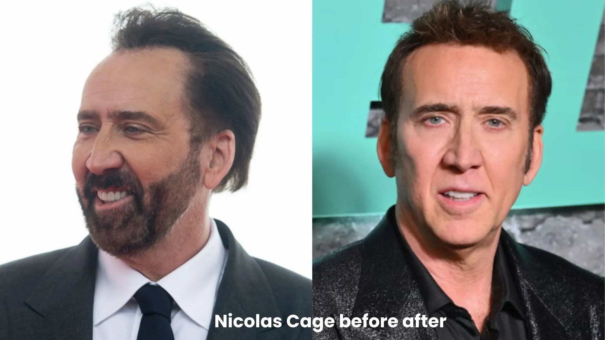 Nicolas Cage hair transplant