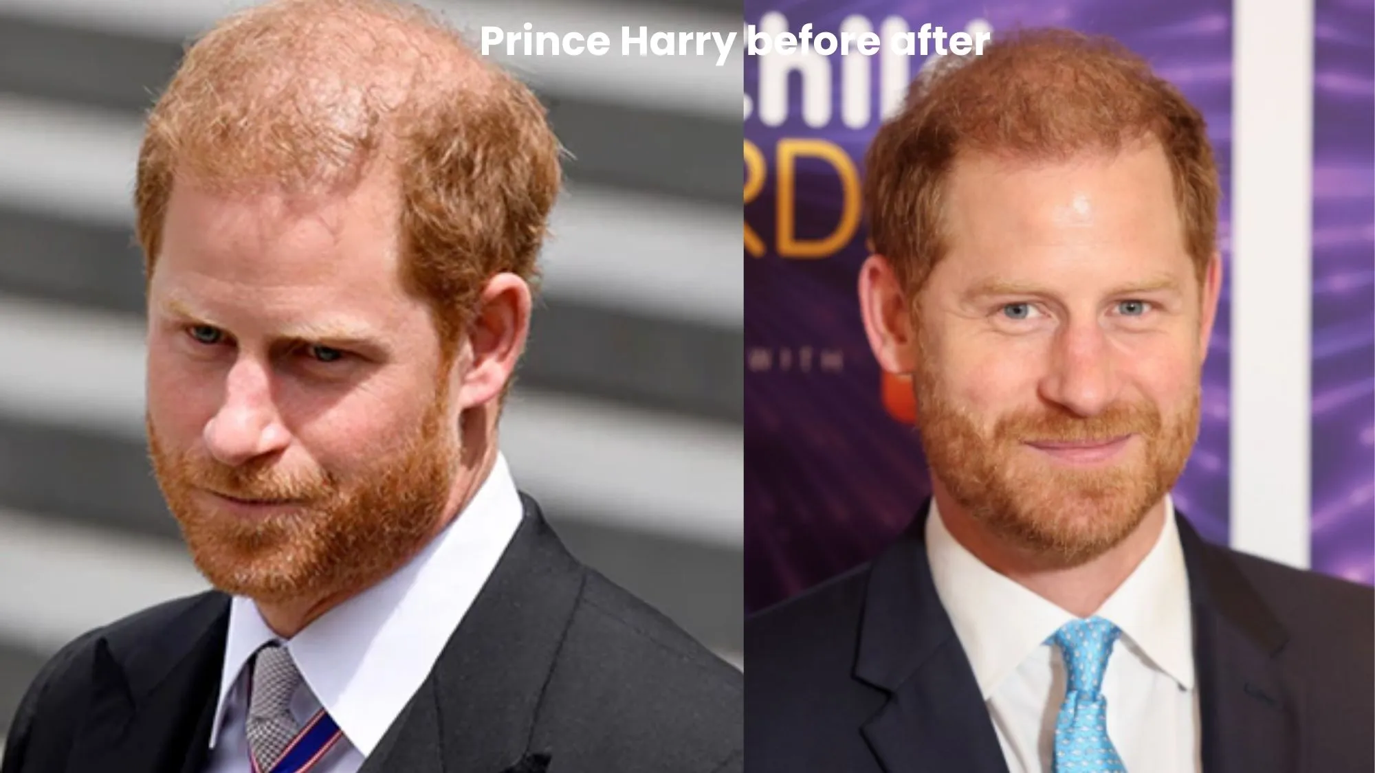 Prince Harry hair transplant