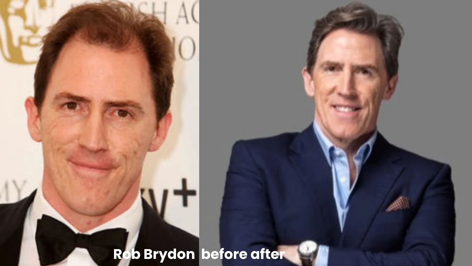 Rob Brydon hair transplant