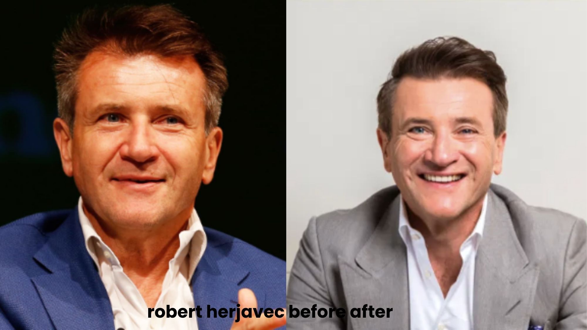 Robert Herjavec hair transplant