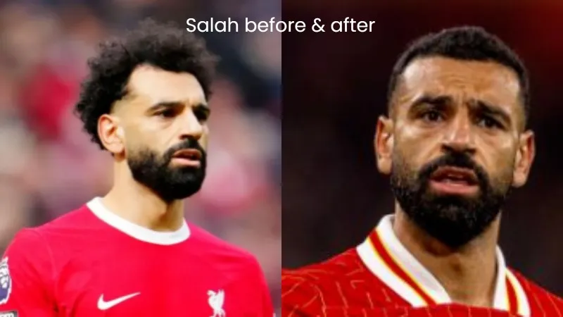 Mo Salah hair transplant