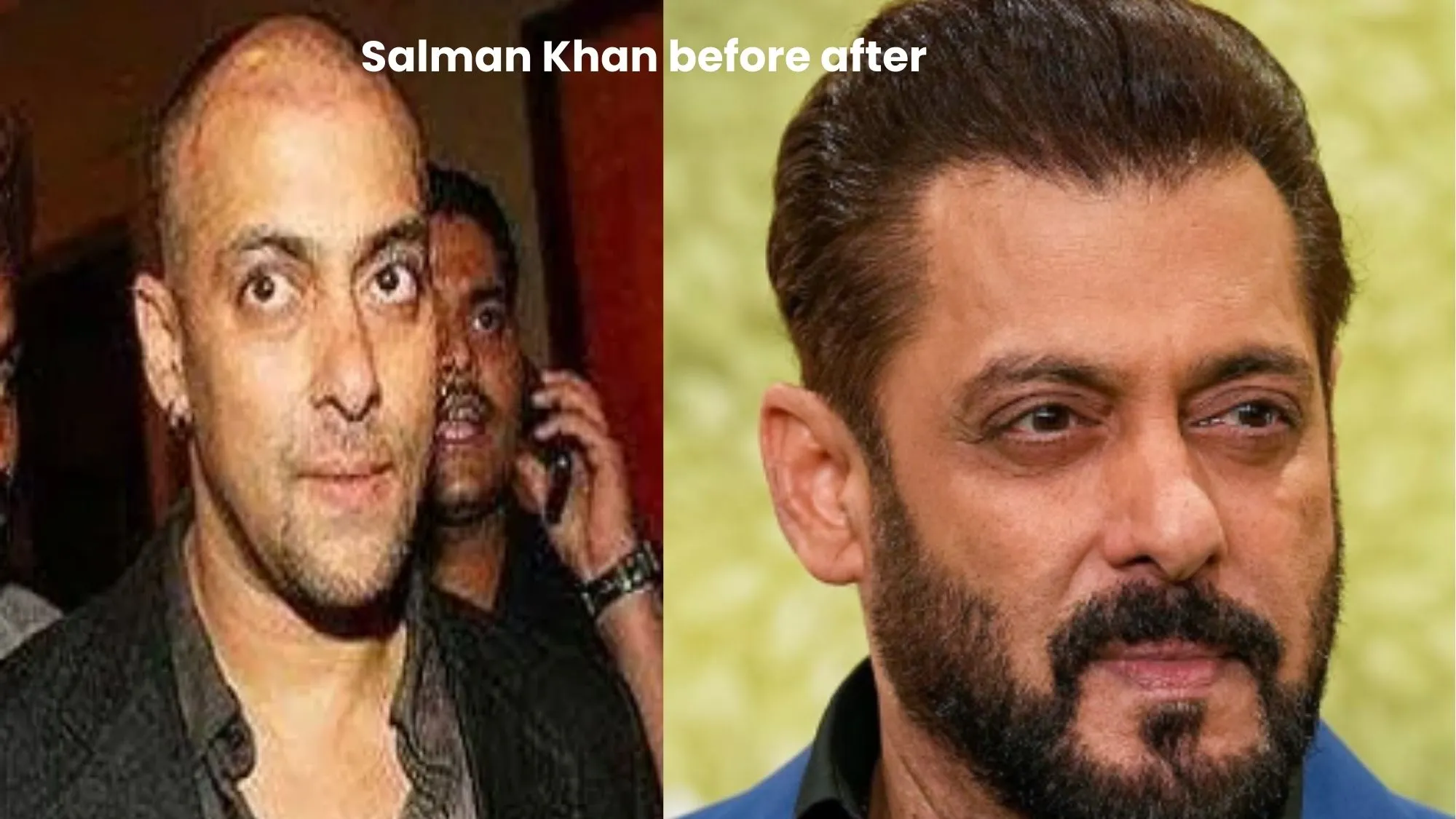 Salman Khan hair transplant