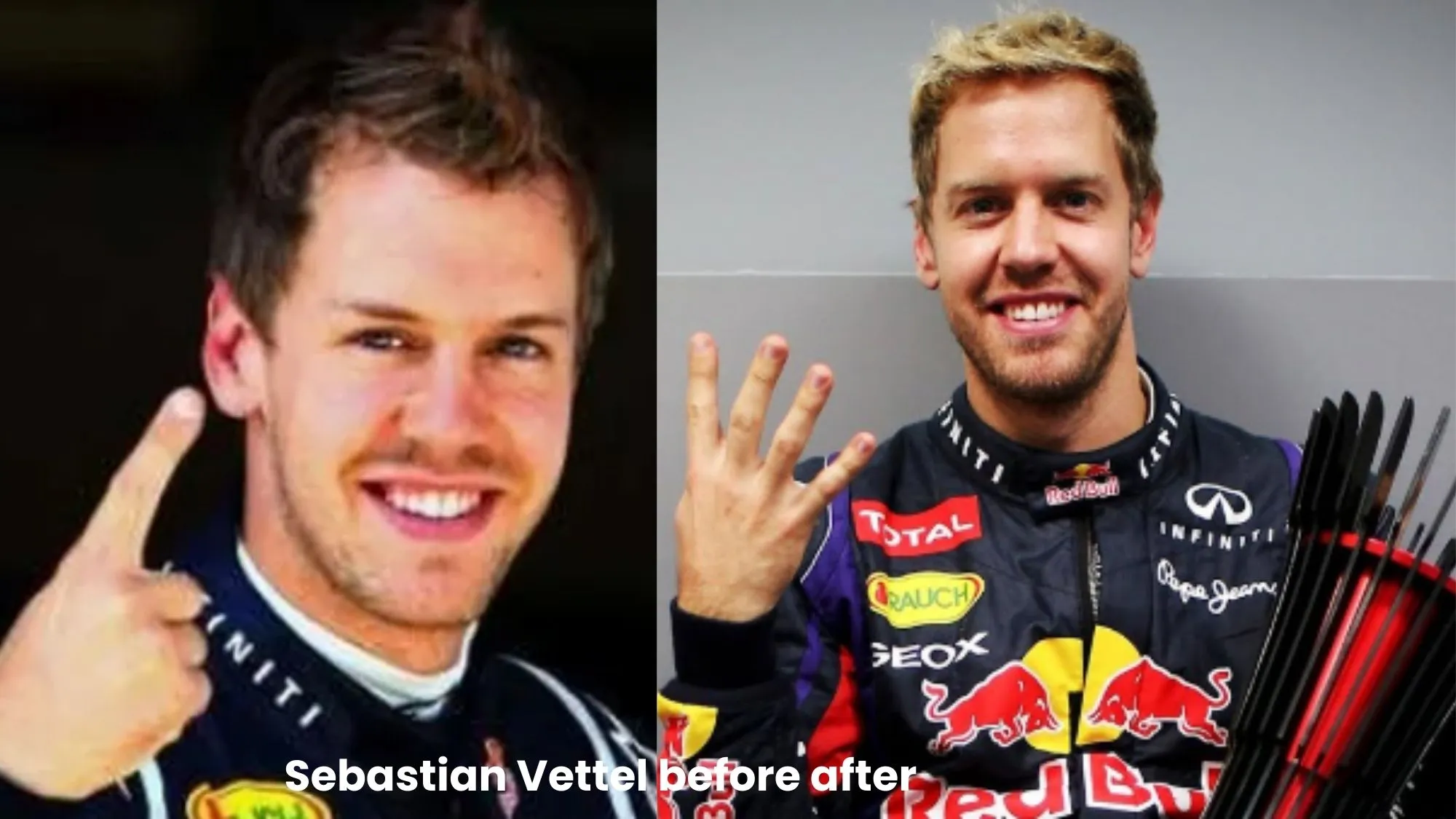 Sebastian Vettel hair transplant