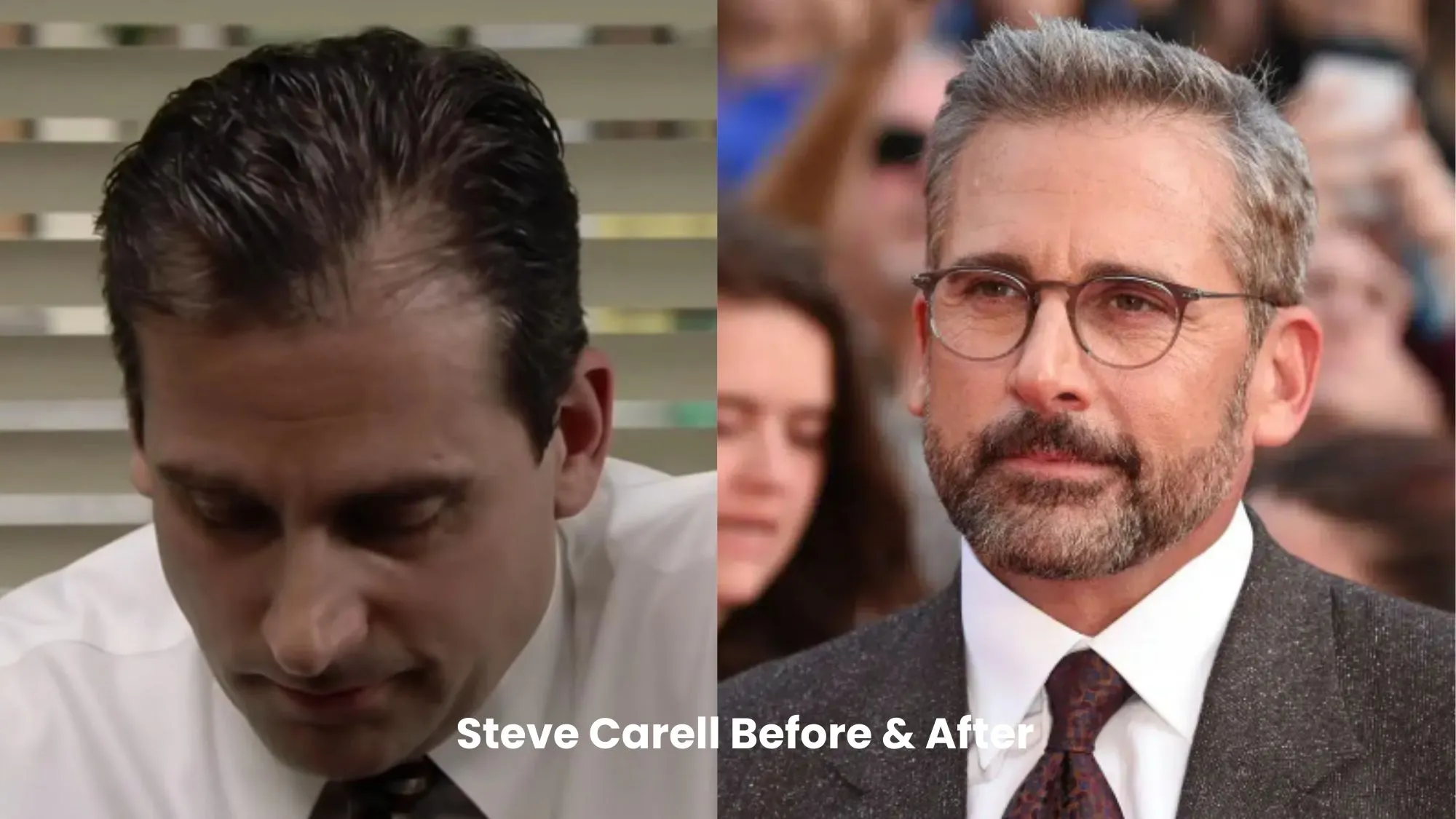 Steve Carell hair transplant