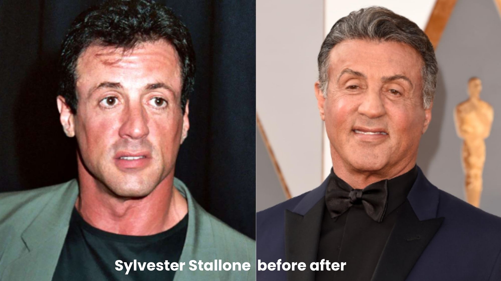 Sylvester Stallone hair transplant