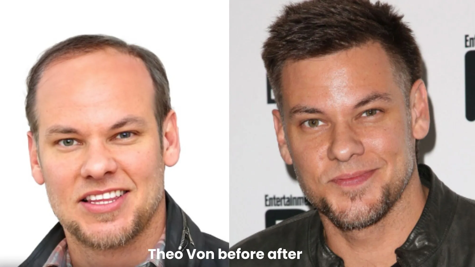 Theo Von hair transplant