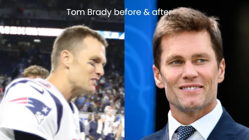 Tom Braddy hair transplant