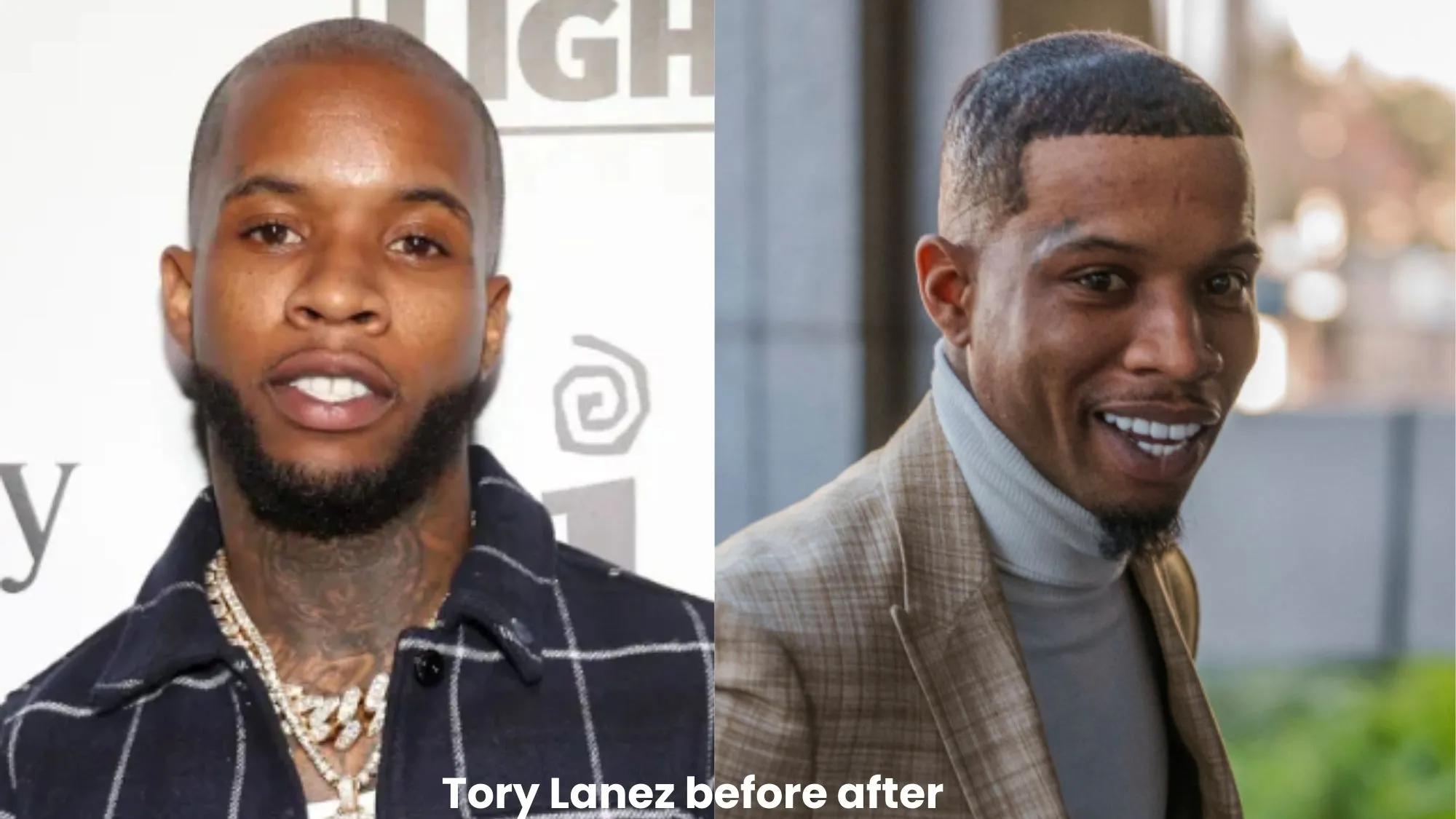 Tory Lanez hair transplant