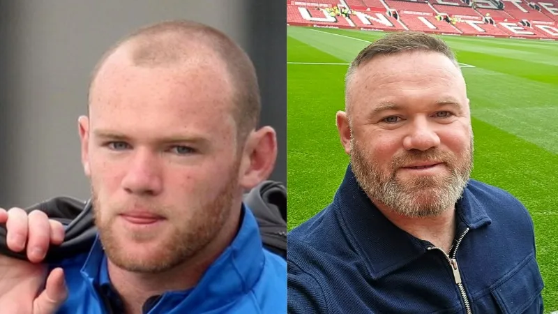 Wayne Rooney hair transplant