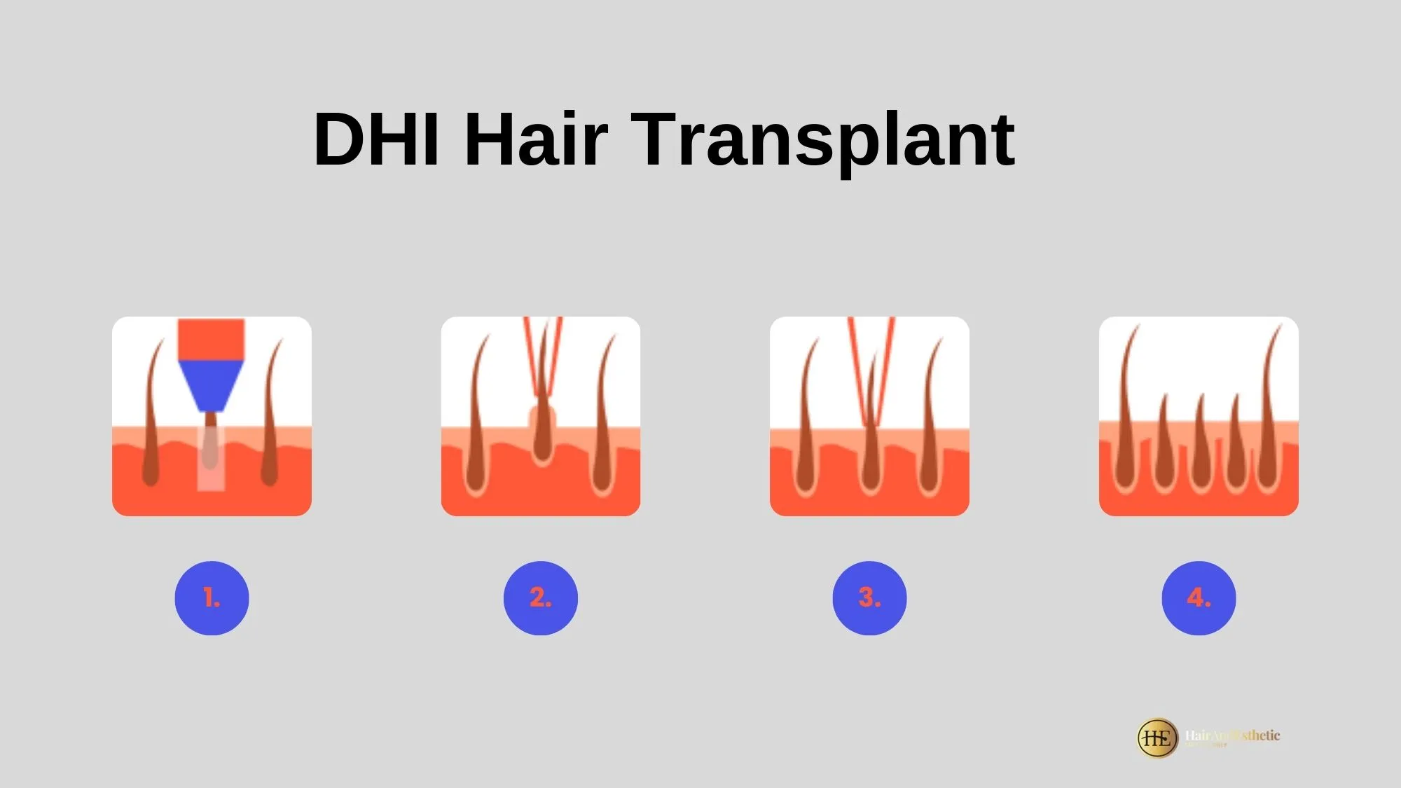 DHI hair transplant procedure in Turkey