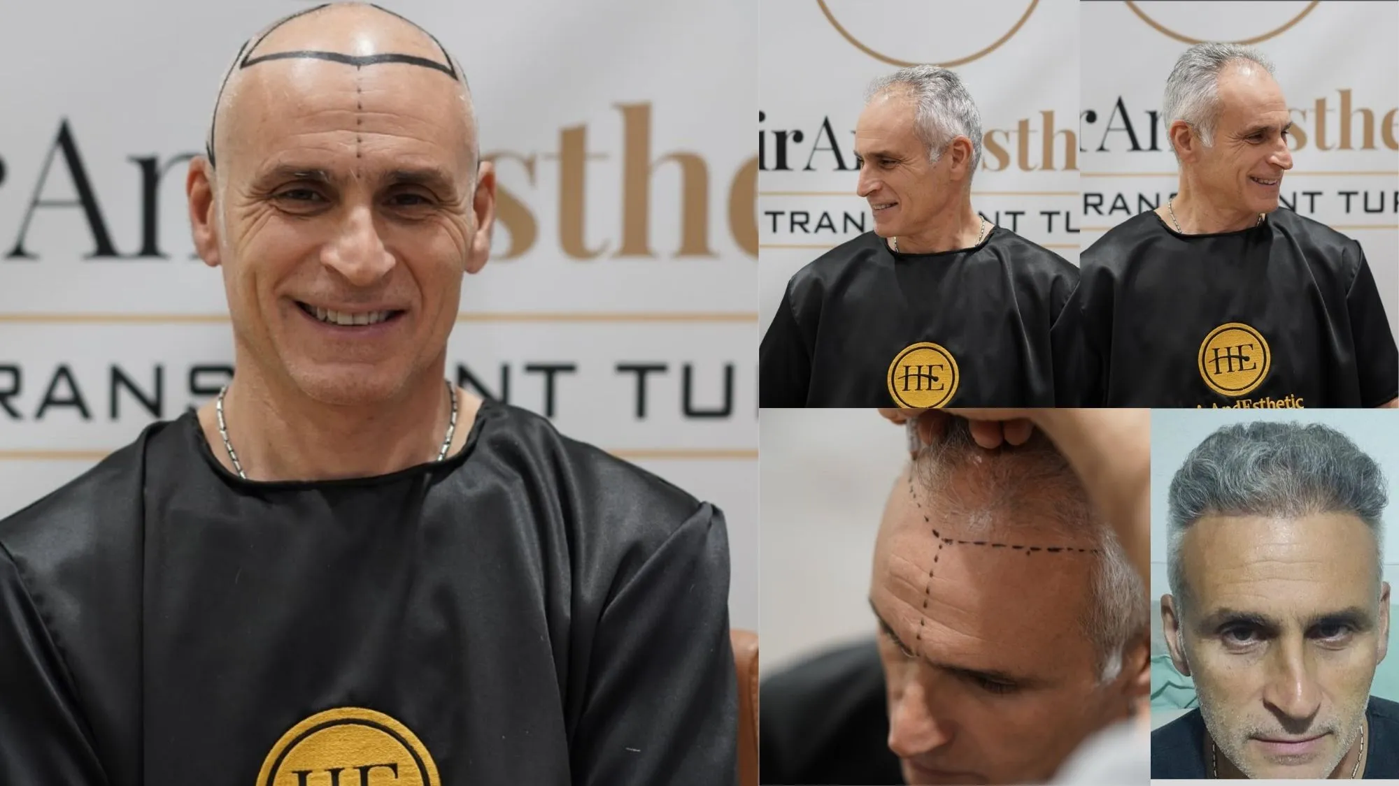 DHI hair transplant Istanbul