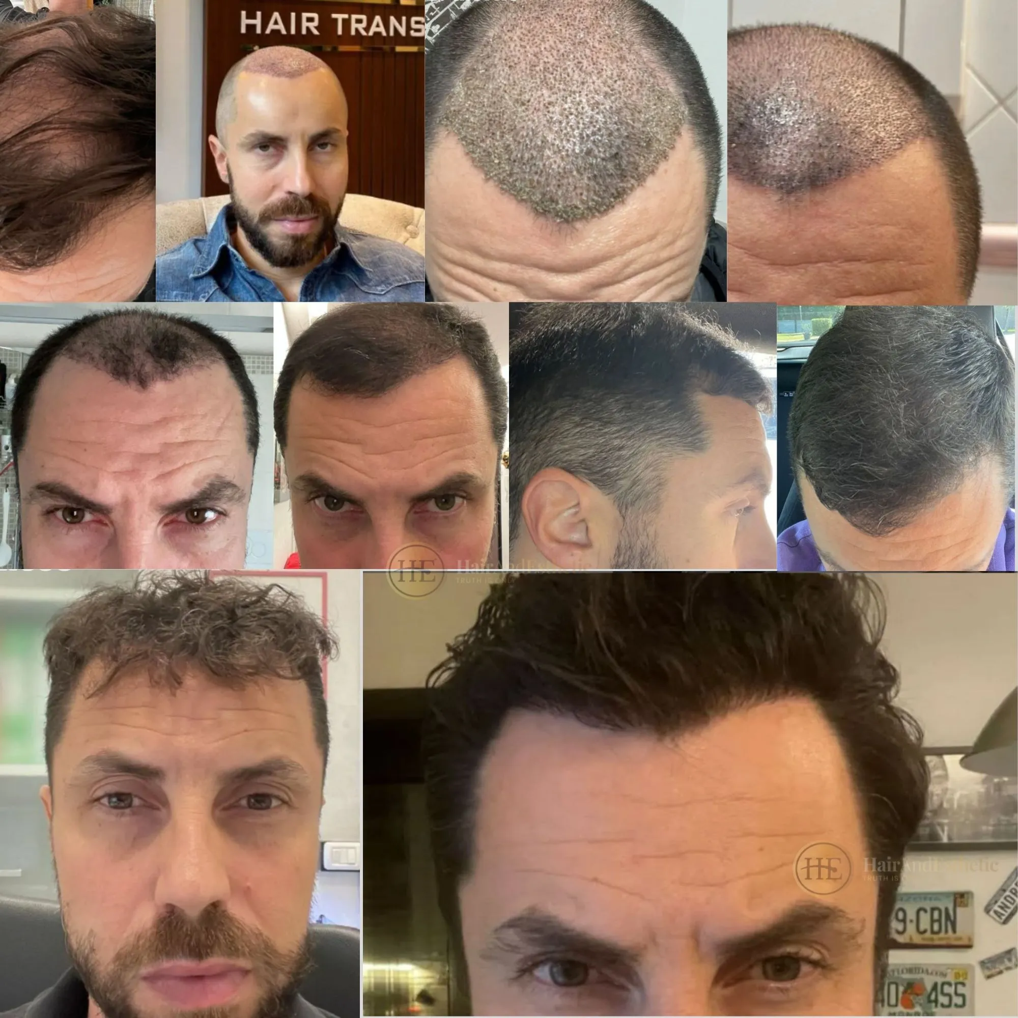 DHI hair transplant before and after