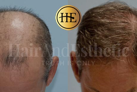 fue-hair-transplantation-technique