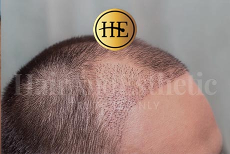 fue-hair-transplantation in Istanbul