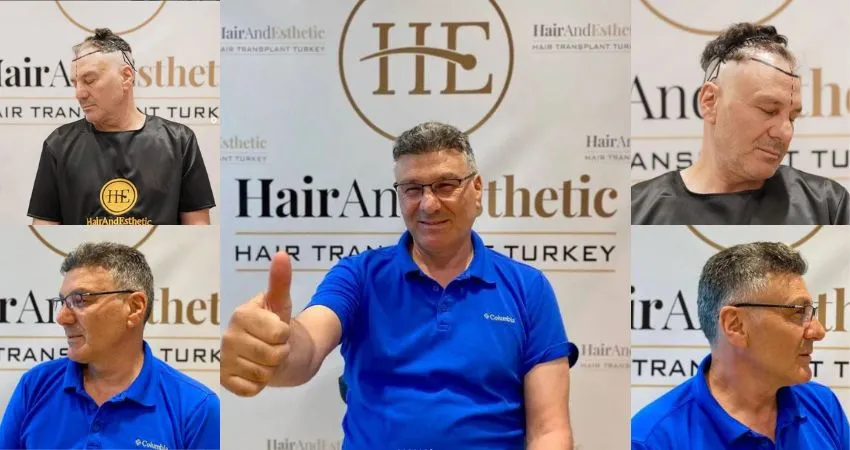 Fue hair transplant Istanbul