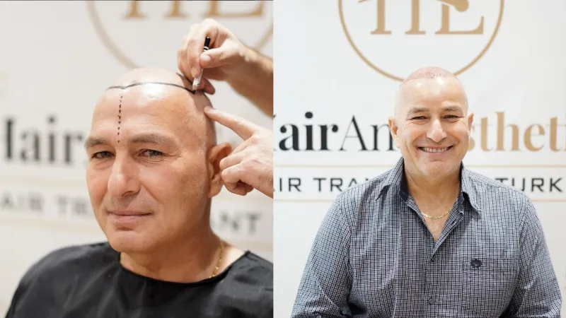 Painless fue hair transplant Turkey