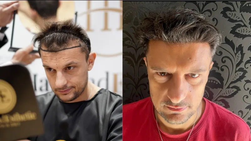 Fue hair transplant costs Turkey